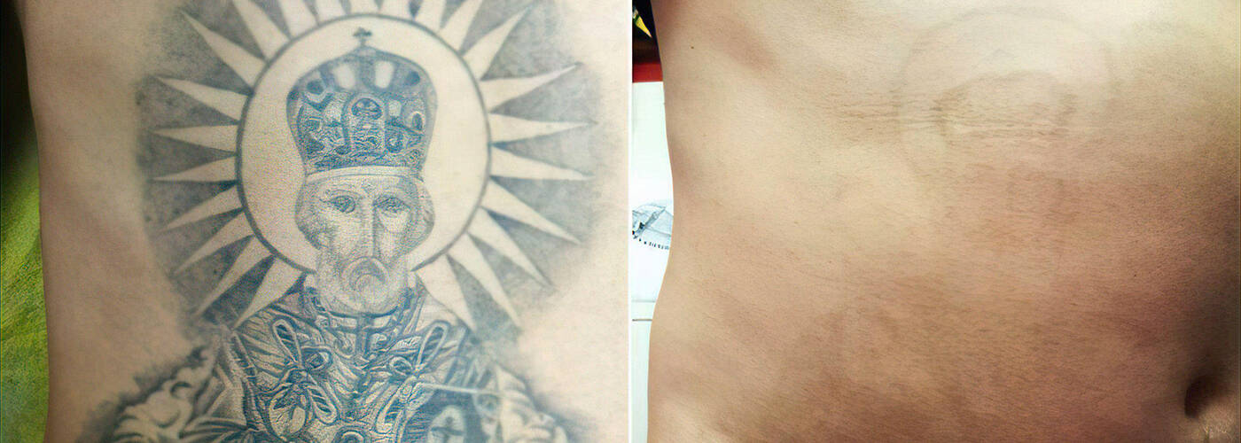 Удаление татуировки и перманентного макияжа лазером